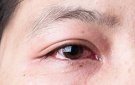 CÁCH PHÒNG BỆNH ĐAU MẮT ĐỎ (HƯỚNG DẪN CỦA BỘ Y TẾ)